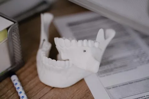 3D plaster model of an orthodontic bone with a screwed in screw Stock Photos