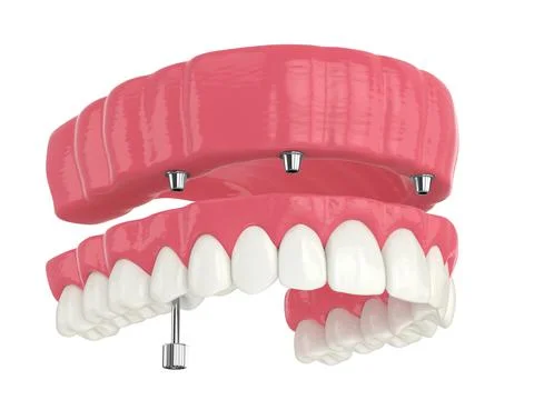 3d render of all on 4 dental implants treatment Stock Illustration