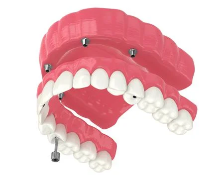 3d render of all on 4 dental implants treatment Stock Illustration