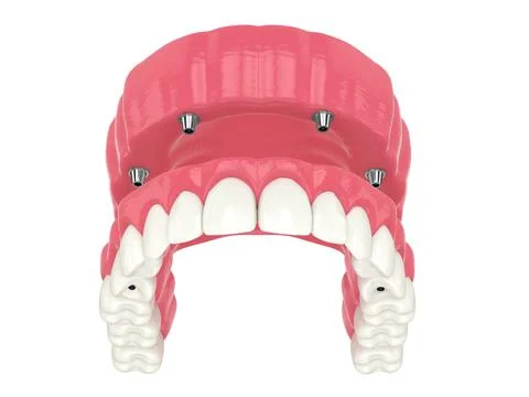 3d render of all on 4 dental implants treatment Stock Illustration