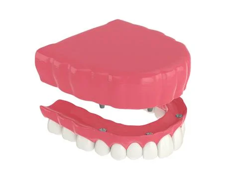 3d render of all on 4 dental implants treatment Illustrazione stock