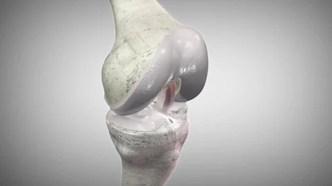 3d render arthritis knee joint by Polymime http://www.polymime.com Stock Footage