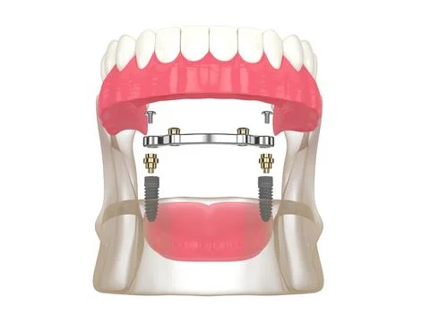 3d render of bar retained removable overdenture installation supported by t.. Stock Illustration
