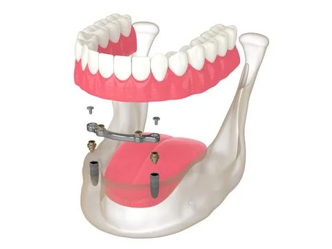 3d render of bar retained removable overdenture installation supported by t.. Illustrazione stock