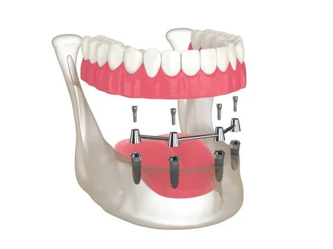 3d render of bar retained removable overdenture installation supported by f.. Stock Illustration