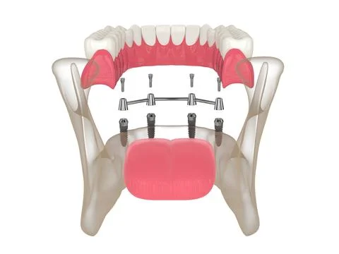 3d render of bar retained removable overdenture installation supported by f.. Stock Illustration