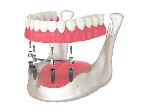 3d render of bar retained removable overdenture installation supported by f.. Stock Illustration