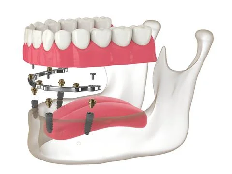 3d render of bar retained removable overdenture installation supported by i.. Stock Illustration