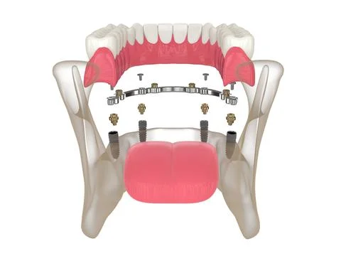 3d render of bar retained removable overdenture installation supported by i.. Stock Illustration