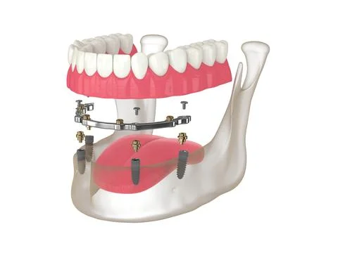 3d render of bar retained removable overdenture installation supported by i.. Stock Illustration