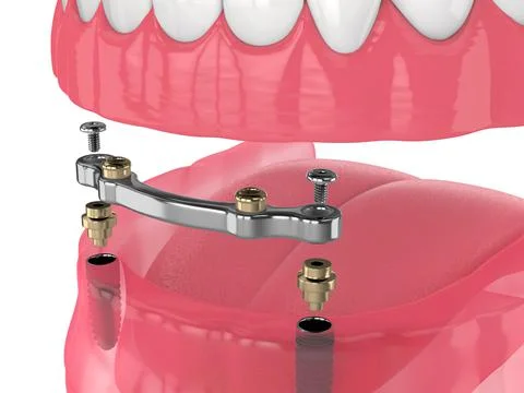 3d render of bar retained removable overdenture installation supported by two 스톡 사진