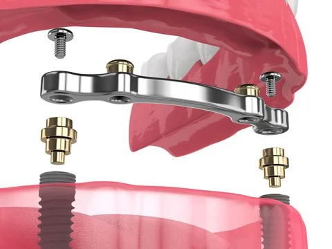 3d render of bar retained removable overdenture installation supported by two 스톡 사진