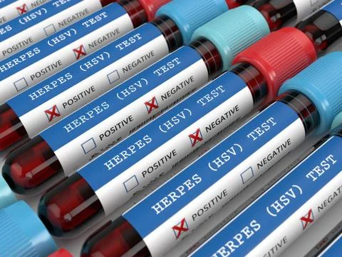 3d render of  blood samples with herpes test Stock Illustration