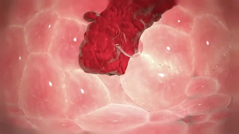 3D render cancerous polyp cells. http://www.polymime.com Stock Footage 75364771