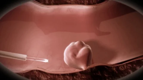 3D render colon polyp removal endoscope by Polymime http://www.polymime.com Stock Footage 75406440