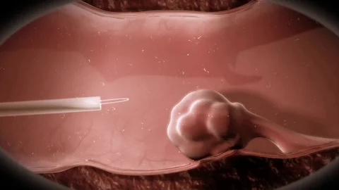 3D render colon polyp removal colonoscopy by Polymime http://www.polymime.com Stock Footage 75406448
