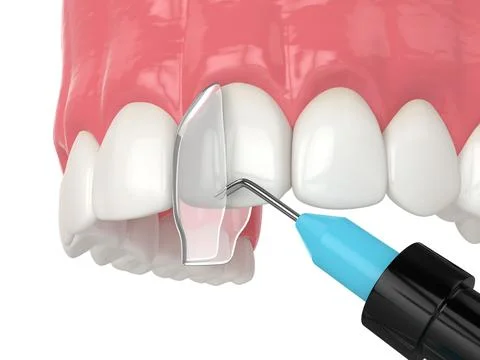 3d render of crooked tooth treatment using bonding procedure Stock Illustration