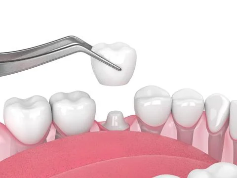 3d render of crown replacement on reshaped tooth Stock Illustration