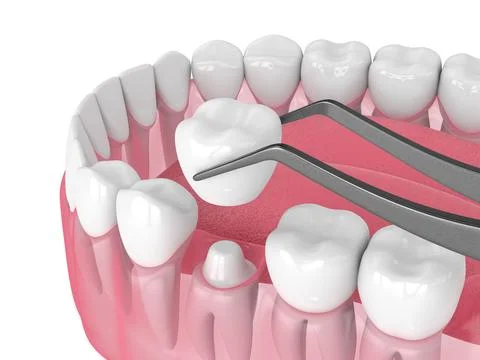 3d render of crown replacement on reshaped tooth Stock-Illustration