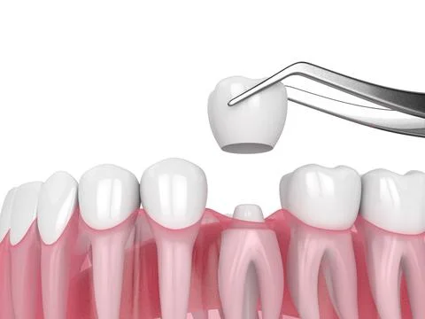3d render of crown replacement on reshaped tooth Stock Illustration
