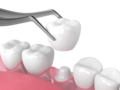 3d render of crown replacement on reshaped tooth Stock Illustration