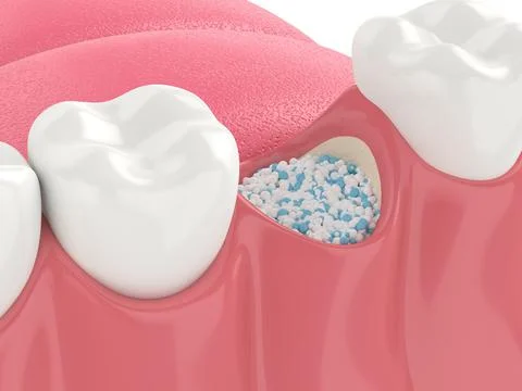 3D render of dental bone grafting with dental bone biomaterial in alveolar Stock Illustration