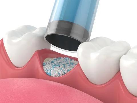 3D render of dental bone grafting with dental bone biomaterial application Stock Illustration