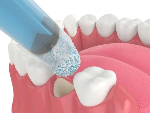 3D render of dental bone grafting with dental bone biomaterial application Stock Illustration