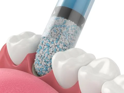 3D render of dental bone grafting with dental bone biomaterial application Stock Illustration