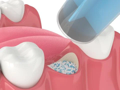 3D render of dental bone grafting with dental bone biomaterial application Stock Illustration