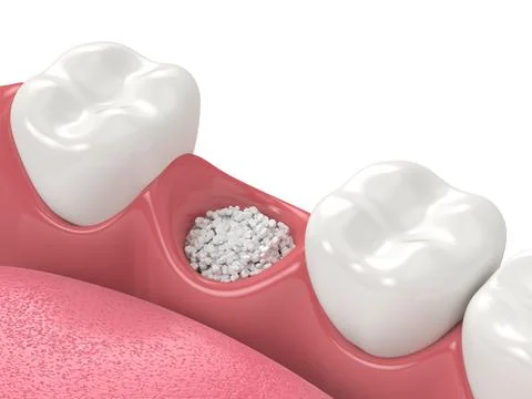 3D render of dental bone grafting with dental bone biomaterial Stock-Illustration