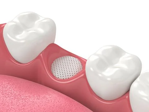 3D render of dental bone grafting with membrane Stock Illustration