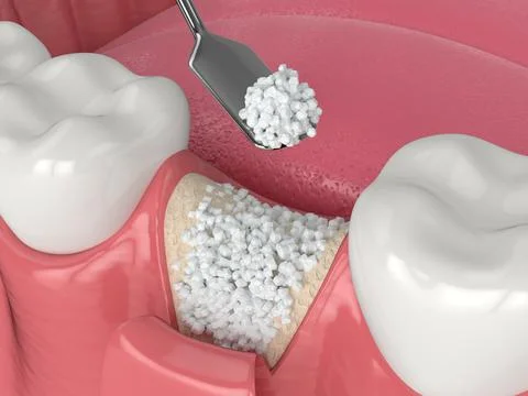 3D render of dental bone grafting with bone biomaterial application Stock Illustration