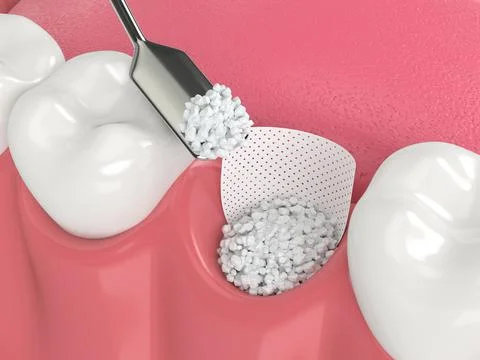 3D render of dental bone grafting with bone biomaterial and membrane Stock Illustration
