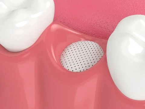 3D render of dental bone grafting with membrane Stock Photos