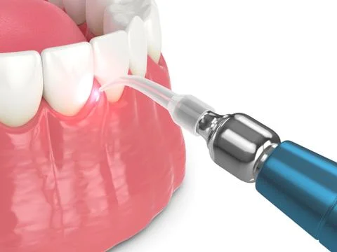 3d render of dental diode laser used to treat gums Stock Illustration