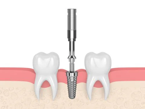 3d render of dental implant with multipeg to check implant stability Stock Illustration
