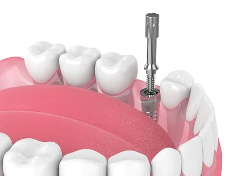 3d render of dental implant with multipeg to check implant stability Stock Illustration