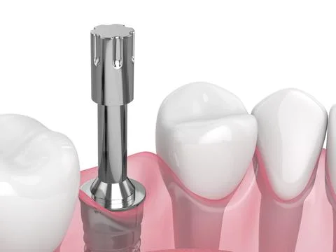 3d render of dental implant with multipeg to check implant stability Illustrazione stock