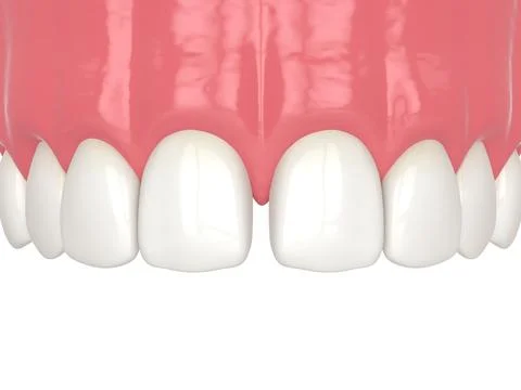 3d render of diastema closure using bonding procedure Stock Illustration