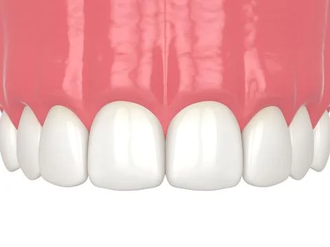 3d render of diastema closure using bonding procedure Stock Illustration