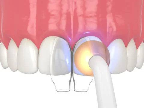 3d render of diastema closure using bonding procedure Stock Illustration