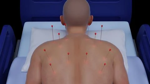 3D Render of Dry Needling Therapy Treatment. Medical Treatment with Dry Needling Stock Illustration