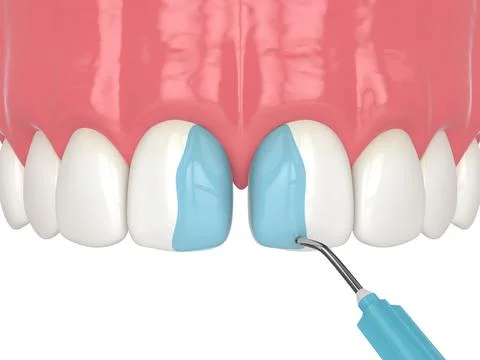 3d render of etching the enamel with a mild acid as a part of bonding procedu Stock Illustration
