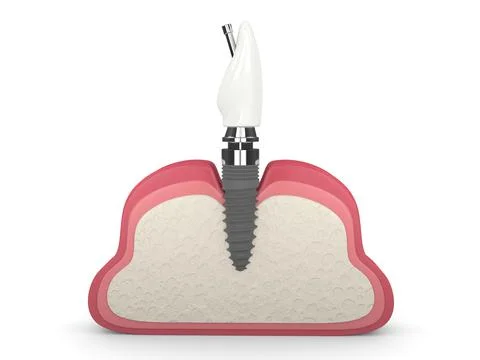 3d render of gum cross-section with incisor implant placement Stock Illustration