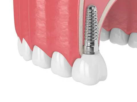 3d render of gum cross-secton with implant placement Stock Illustration