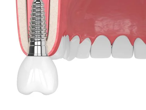 3d render of gum cross-secton with implant placement Stock Illustration