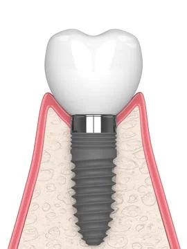 3d render of gum cross-secton with implant placement Stock Illustration