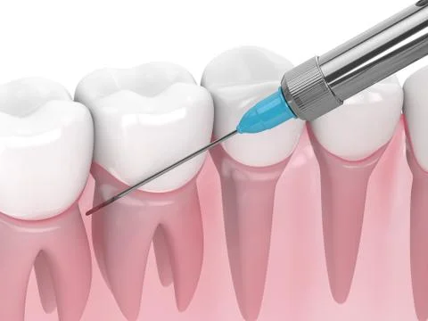 3d render of gums and syringe with dental anesthesia Stock Photos