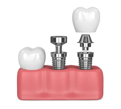 3d render of gums with implanting tooth procedure Illustrazione stock